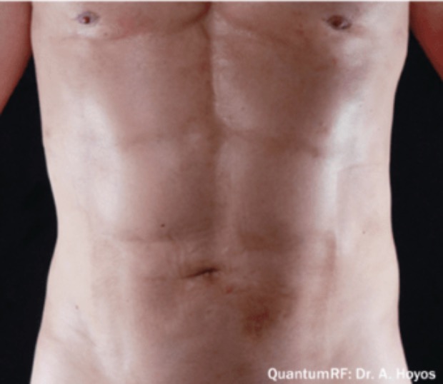 Quantum RF after &mdash; actual patient